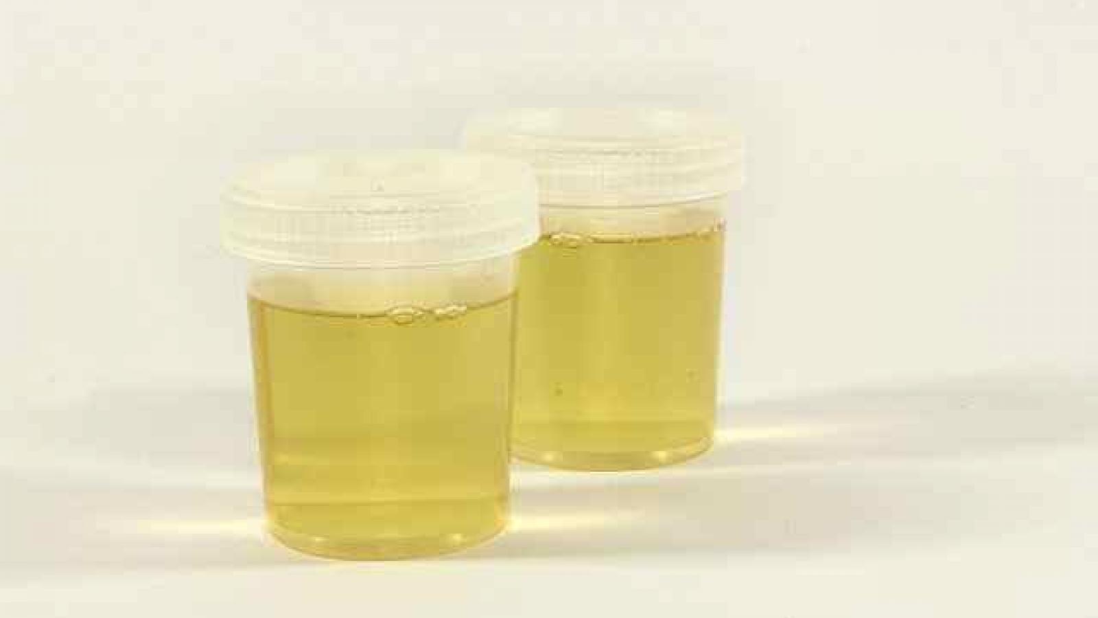 Jars of urine